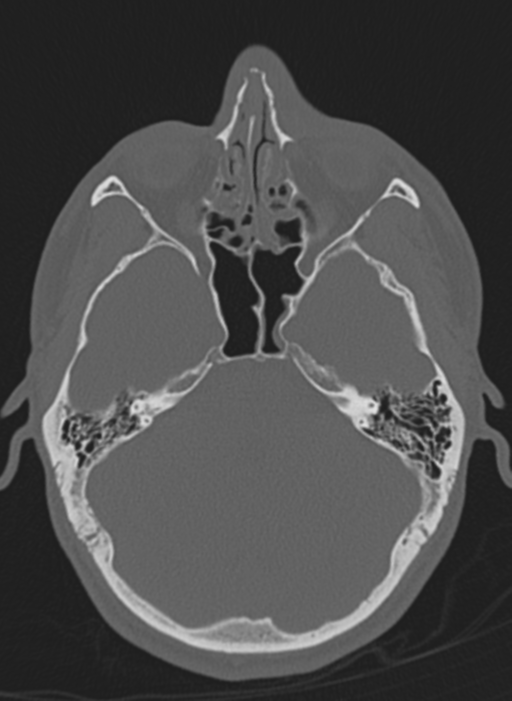Anaplastic oligodendroglioma with skull fracture (Radiopaedia 74831-85846 Axial bone window 55).png