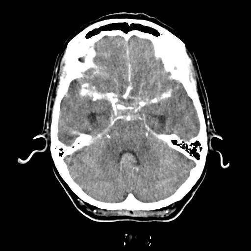 Aneursym related subarachnoid hemorrhage with hydrocephalus (Radiopaedia 45105-49084 D 16).jpg