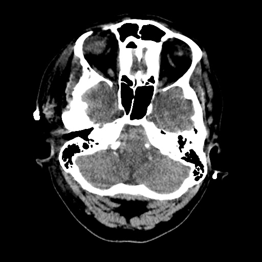 Aneursym related subarachnoid hemorrhage with hydrocephalus (Radiopaedia 45105-49085 Axial non-contrast 8).jpg