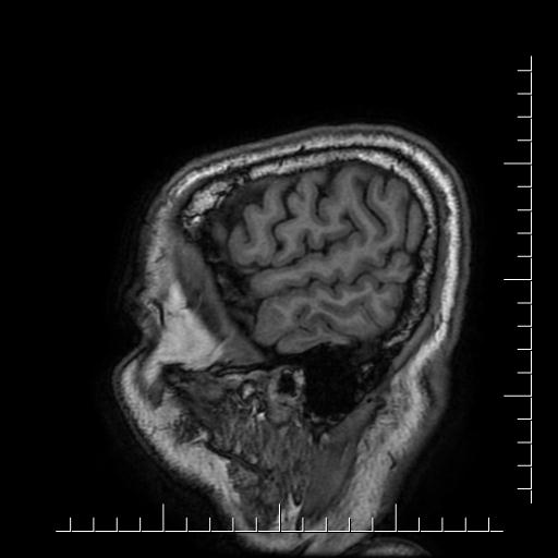 File:Aneurysm of posterior communicating artery (Radiopaedia 20188-20163 Sagittal T1 7).jpg