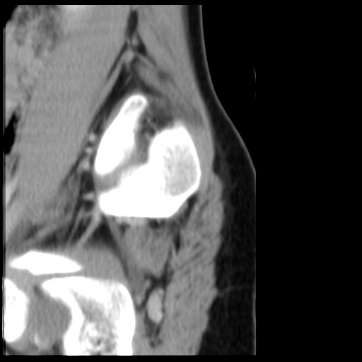 File:Aneurysmal bone cyst - sacrum (Radiopaedia 65190-74195 A 29).jpg