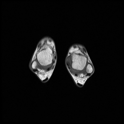 File:Aneurysmal bone cyst - tibia (Radiopaedia 22343-22367 Axial T1 18).jpg