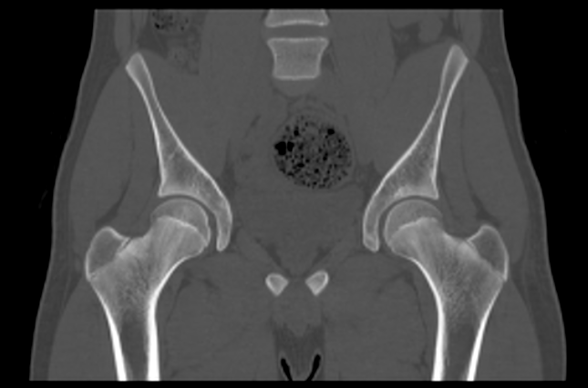 File:Aneurysmal bone cyst of ischium (Radiopaedia 25957-26094 Coronal bone window 18).png