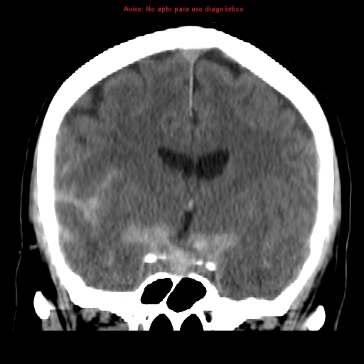 File:Aneurysmal subarachnoid hemorrhage (Radiopaedia 24740-24997 Coronal non-contrast 20).jpg