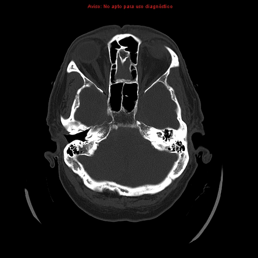 File:Aneurysmal subarachnoid hemorrhage (Radiopaedia 24740-24997 bone window 9).jpg