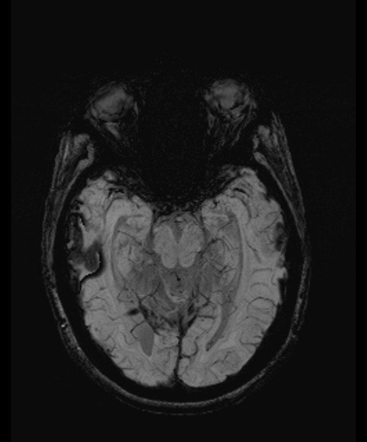 Angiomatous meningioma (Radiopaedia 79459-92579 E 23).jpg