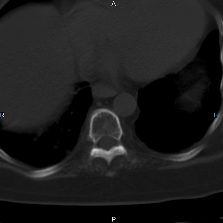 Ankylosing spondylitis (Radiopaedia 8748-9556 Axial bone window 2).jpg