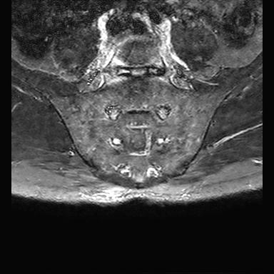 File:Ankylosing spondylitis with zygapophyseal arthritis (Radiopaedia 38433-40517 D 6).jpg
