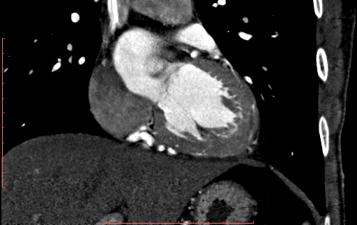 Anomalous left coronary artery from the pulmonary artery (ALCAPA) (Radiopaedia 70148-80181 B 156).jpg