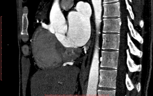 File:Anomalous left coronary artery from the pulmonary artery (ALCAPA) (Radiopaedia 70148-80181 C 115).jpg