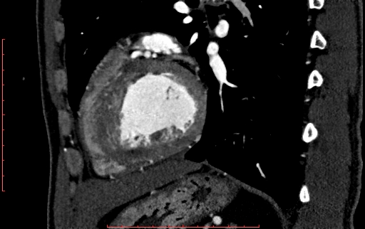 File:Anomalous left coronary artery from the pulmonary artery (ALCAPA) (Radiopaedia 70148-80181 C 178).jpg