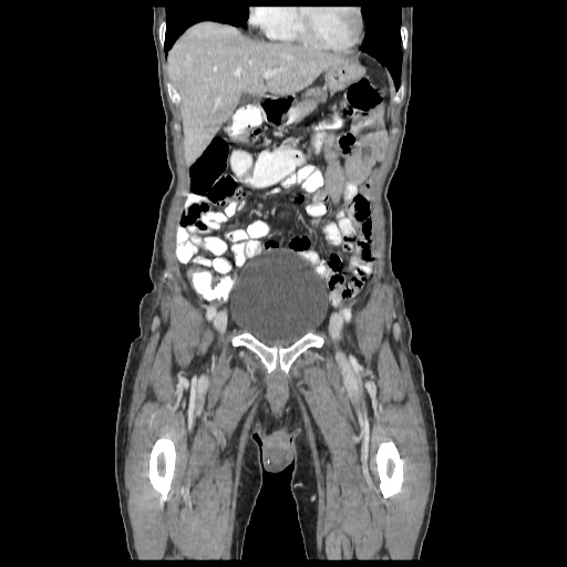 Anorectal carcinoma (Radiopaedia 44413-48064 B 16).jpg