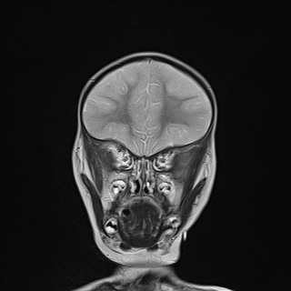 File:Anoxic brain injury (Radiopaedia 79165-92139 Coronal T2 8).jpg