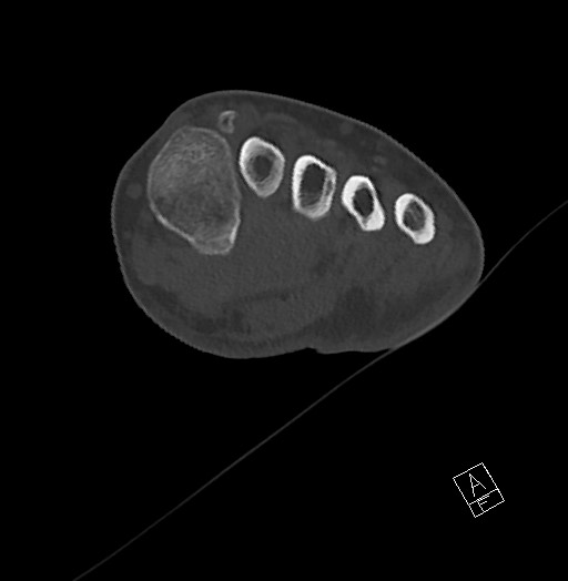 Anterior calcaneal process fracture (Radiopaedia 63353-71943 Axial bone window 67).jpg