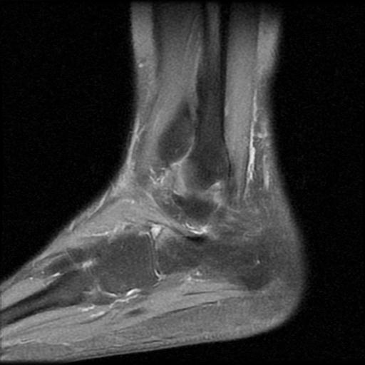 File:Anterior calcaneal process fracture (Radiopaedia 71377-81705 Sagittal PD fat sat 4).jpg
