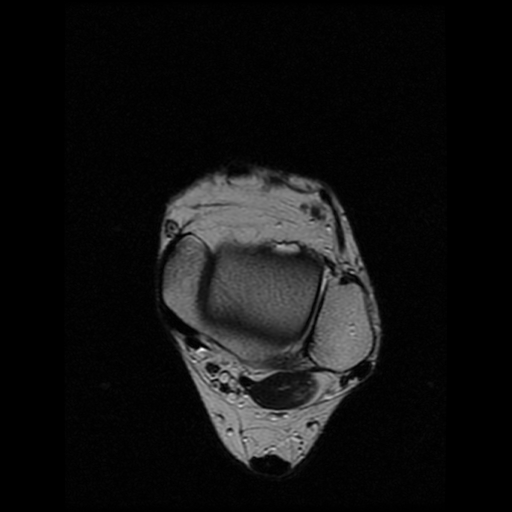 File:Anterior calcaneal process fracture (Radiopaedia 74654-85611 Axial T2 6).jpg