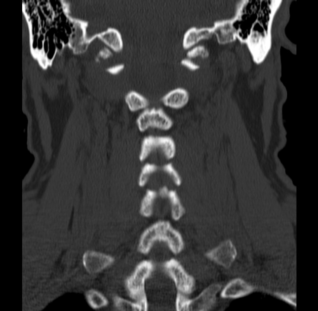 Anterior cervical postdiscectomy arthrodesis (Radiopaedia 32678-33646 Coronal bone window 44).jpg