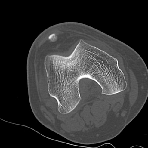 File:Anterior cruciate ligament avulsion fracture (Radiopaedia 58939-66194 Axial bone window 7).jpg