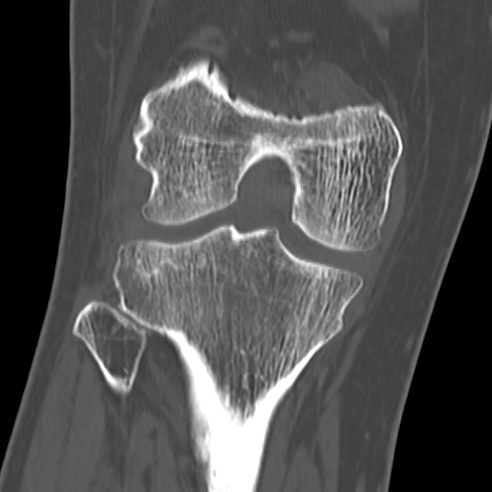 File:Anterior cruciate ligament avulsion fracture (Radiopaedia 58939-66194 Coronal bone window 19).jpg