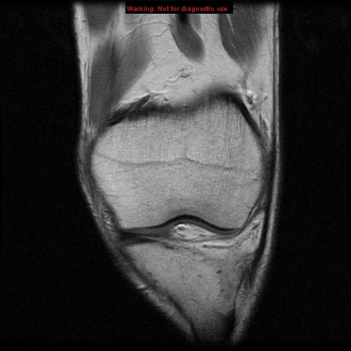 File:Anterior cruciate ligament injury - partial thickness tear (Radiopaedia 12176-12515 D 1).jpg