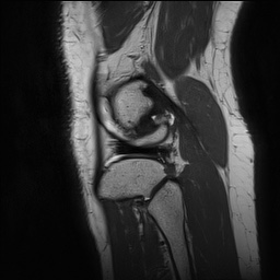 File:Anterior cruciate ligament rupture and posteromedial corner injury (Radiopaedia 67338-76723 Sagittal PD 141).jpg