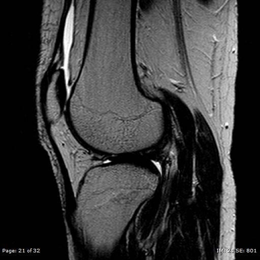 File:Anterior cruciate ligament tear (Radiopaedia 70783-80964 Sagittal T2 21).jpg