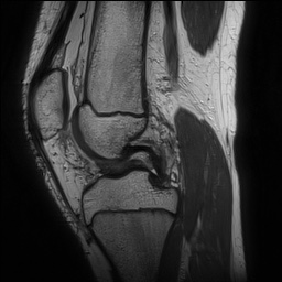 File:Anterior cruciate ligament tear - pediatric (Radiopaedia 62152-70260 Sagittal PD 82).jpg