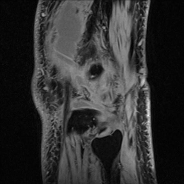 Anterior cruciate ligament tear - ramp lesion (Radiopaedia 71883-82322 Sagittal T1 vibe 21).jpg