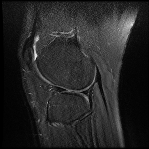 File:Anterior cruciate ligament tear with posteromedial corner injury, bucket-handle meniscal tear and chondral delamination (Radiopaedia 75501-86744 Sagittal PD fat sat 22).jpg
