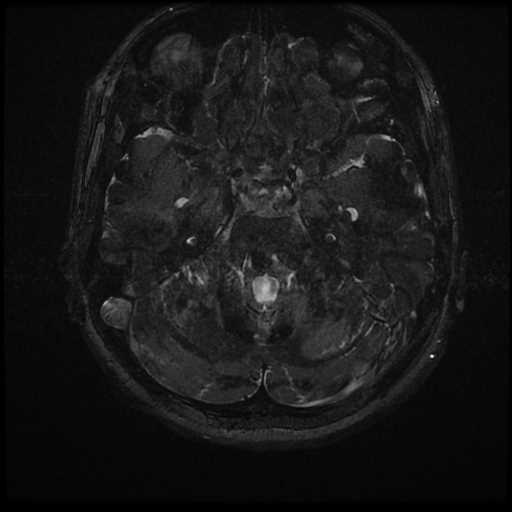 Anterior inferior cerebellar artery vascular loop - type II (Radiopaedia 70991-81209 Axial 3D FIESTA 1).jpg