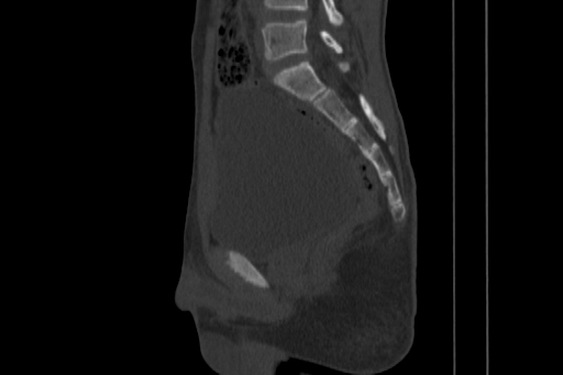Anterior inferior iliac spine avulsion injury (Radiopaedia 88666-105376 Sagittal bone window 51).jpg