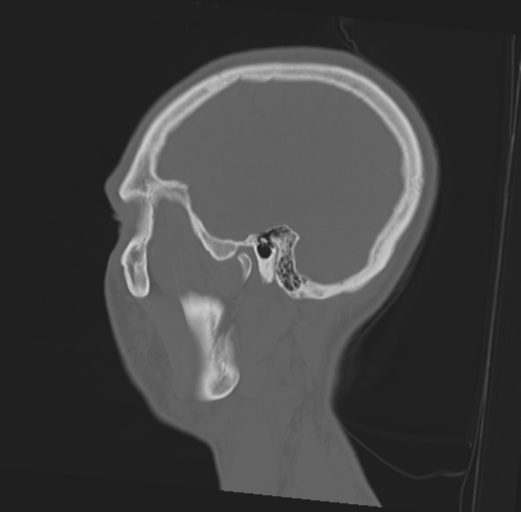 File:Anterior nasal spine fracture (Radiopaedia 46138-50494 Sagittal bone window 14).png