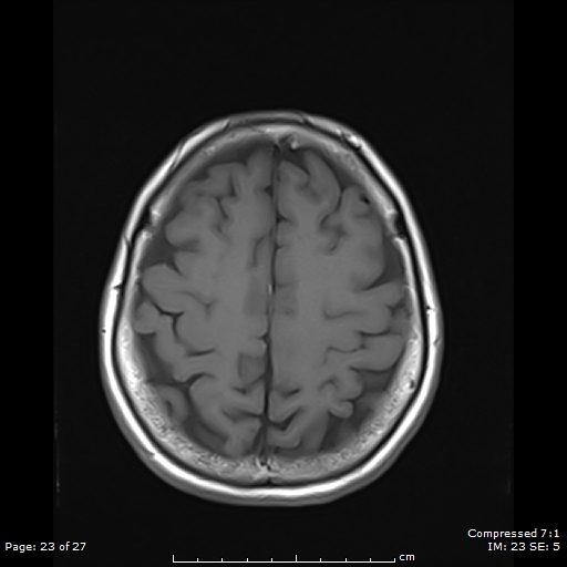 File:Anterior temporal lobe perivascular space (Radiopaedia 88283-104914 Axial T1 23).jpg