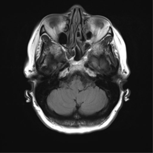 File:Anterior temporal pole cysts (Radiopaedia 46629-51102 Axial FLAIR 5).png