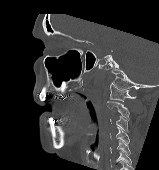 Anterior temporomandibular joint dislocation (Radiopaedia 59430-66784 B 23).jpg