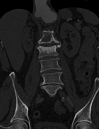 File:Anterior vertebral scalloping (abdominal aortic aneurysm) (Radiopaedia 66744-76067 Coronal bone window 32).jpg