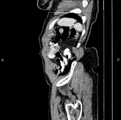 File:Aortic aneurysm and Lemmel syndrome (Radiopaedia 86499-102554 D 83).jpg