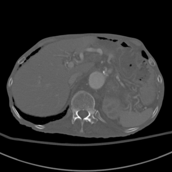 Aortic aneurysm with spinal destruction (Radiopaedia 42301-45410 Axial bone window 21).jpg