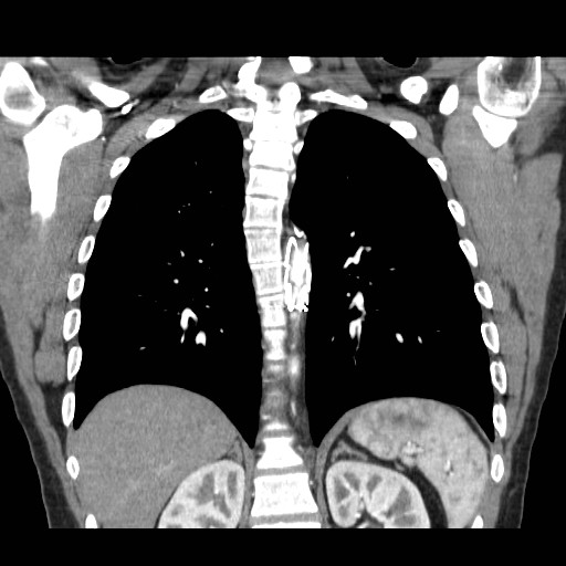 File:Aortic arch stent (Radiopaedia 30030-30595 F 25).jpg