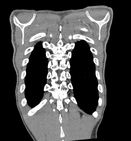Aortic coarctation with aneurysm (Radiopaedia 74818-85828 C 104).jpg