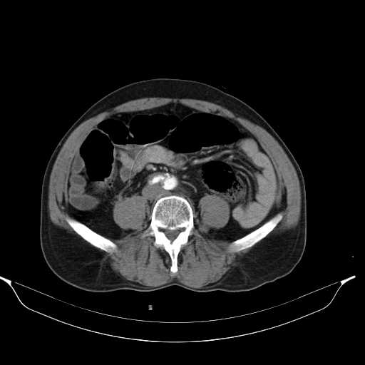 Aortic dissection- Stanford type A (Radiopaedia 22085-22085 A 60).jpg