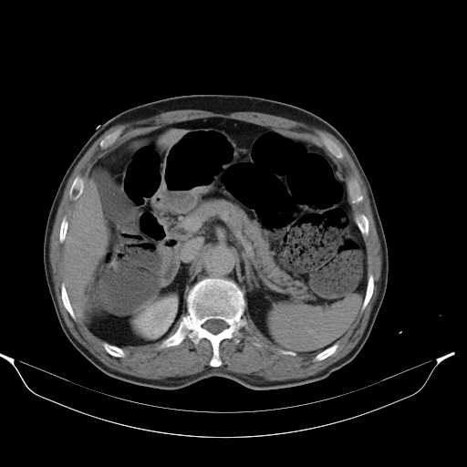 Aortic dissection- Stanford type A (Radiopaedia 22085-22085 Axial C+ delayed 16).jpg