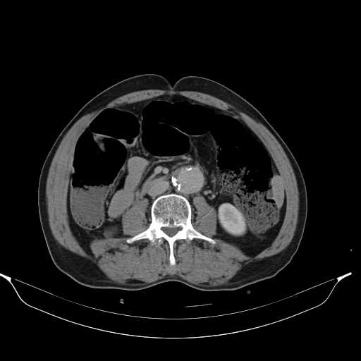 File:Aortic dissection- Stanford type A (Radiopaedia 22085-22085 Axial C+ delayed 28).jpg