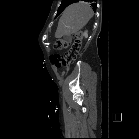 Aortic dissection (CTPA) (Radiopaedia 75506-86750 G 20).jpg