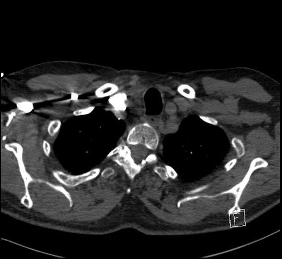 Aortic dissection (CTPA) (Radiopaedia 75506-86751 Axial C+ CTPA 18).jpg