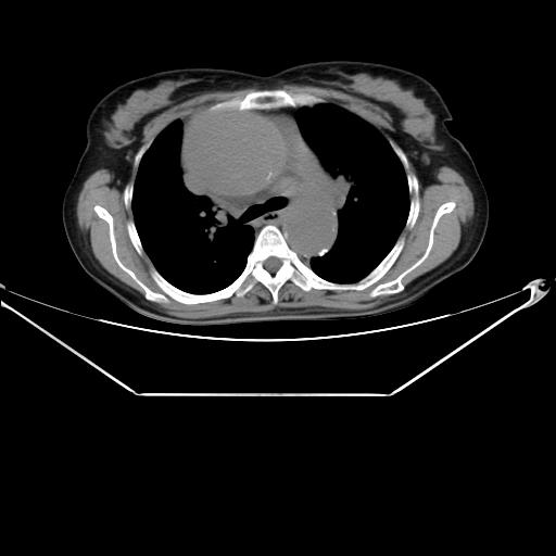 Aortic dissection (Radiopaedia 25350-25604 B 18).jpg