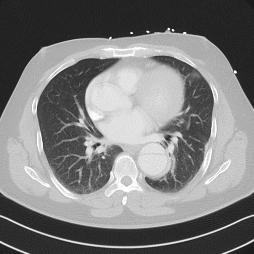 File:Aortic dissection (Radiopaedia 50763-56234 Axial lung window 37).png