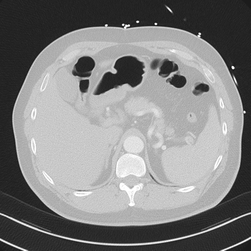 File:Aortic dissection (Radiopaedia 50763-56234 Axial lung window 62).png