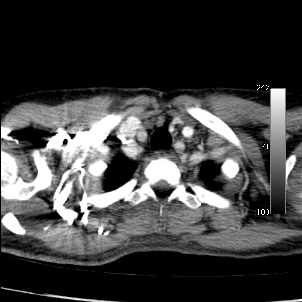 Aortic dissection - Stanford type A (Radiopaedia 29247-29659 A 9).jpg
