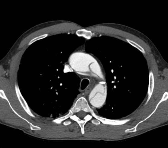 Aortic dissection - Stanford type B (Radiopaedia 73648-84437 A 27).jpg